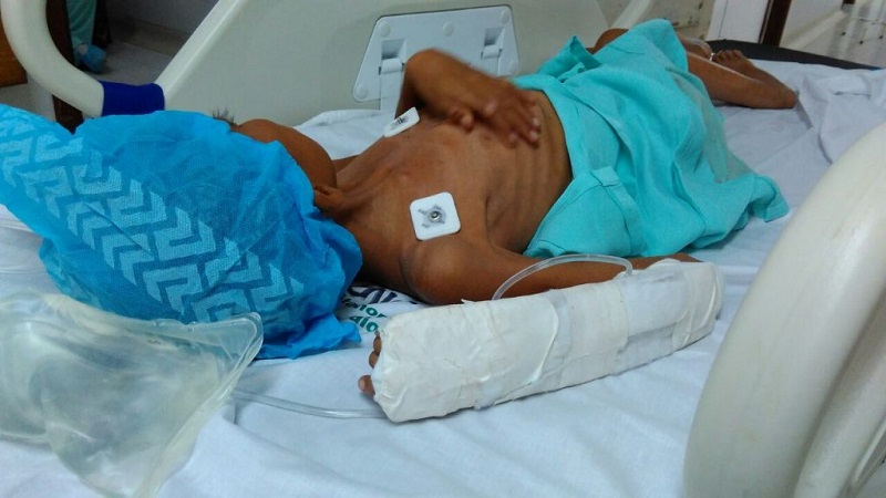 Foto de desnutrición infantil en Valledupar