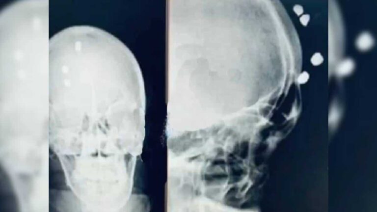 En Aguachica sujeto recibe 4 tiros en la cabeza y no muere 4 tiros en la cabeza y no muere