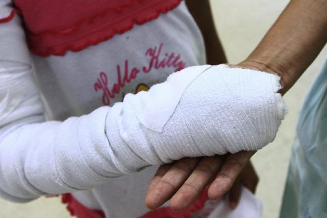 Reportan cuatro quemados con pólvora en el Cesar 5a2df8df5d65d