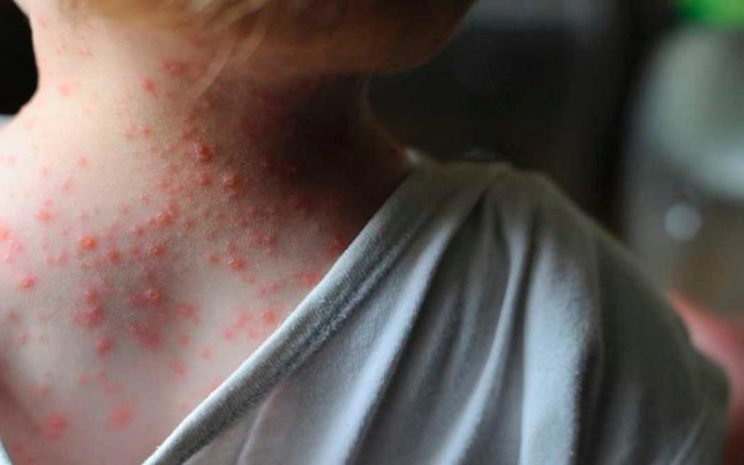 Tres primeros casos de viruela del mono en Colombia | RTA Noticias