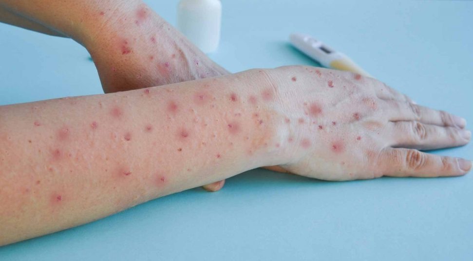 Ascienden los casos de viruela del mono en Colombia | RTA Noticias