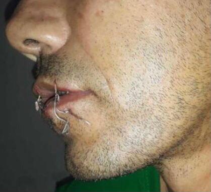 Interno de "La Tramacua" se cosió la boca Interno de "La Tramacua" se cosió la boca | RTA Noticias