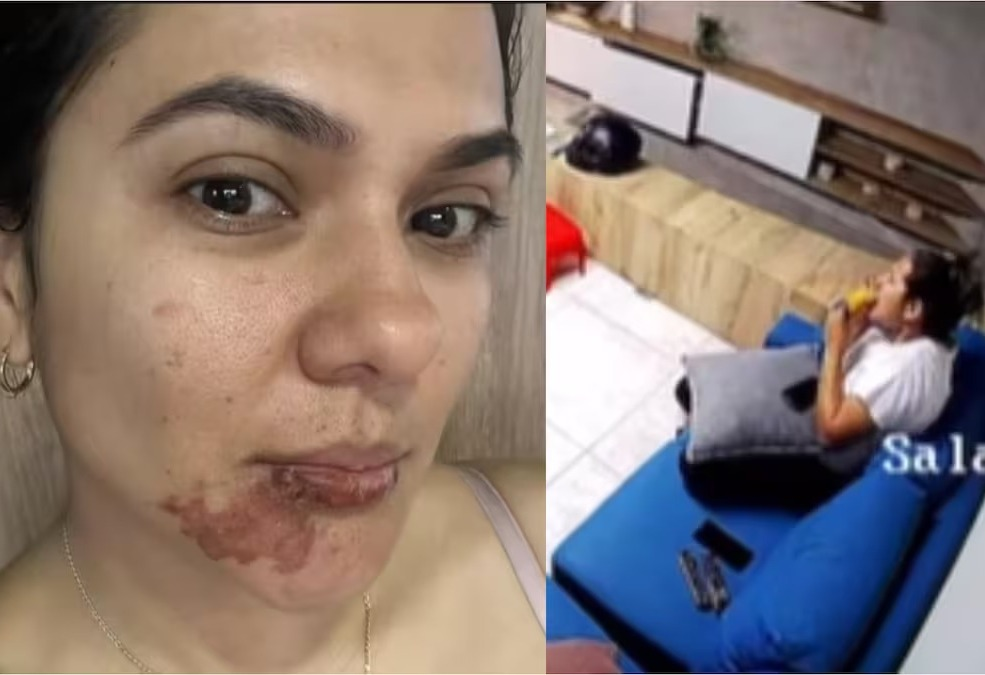 Empanada explota y lesiona a una mujer en el rostro image